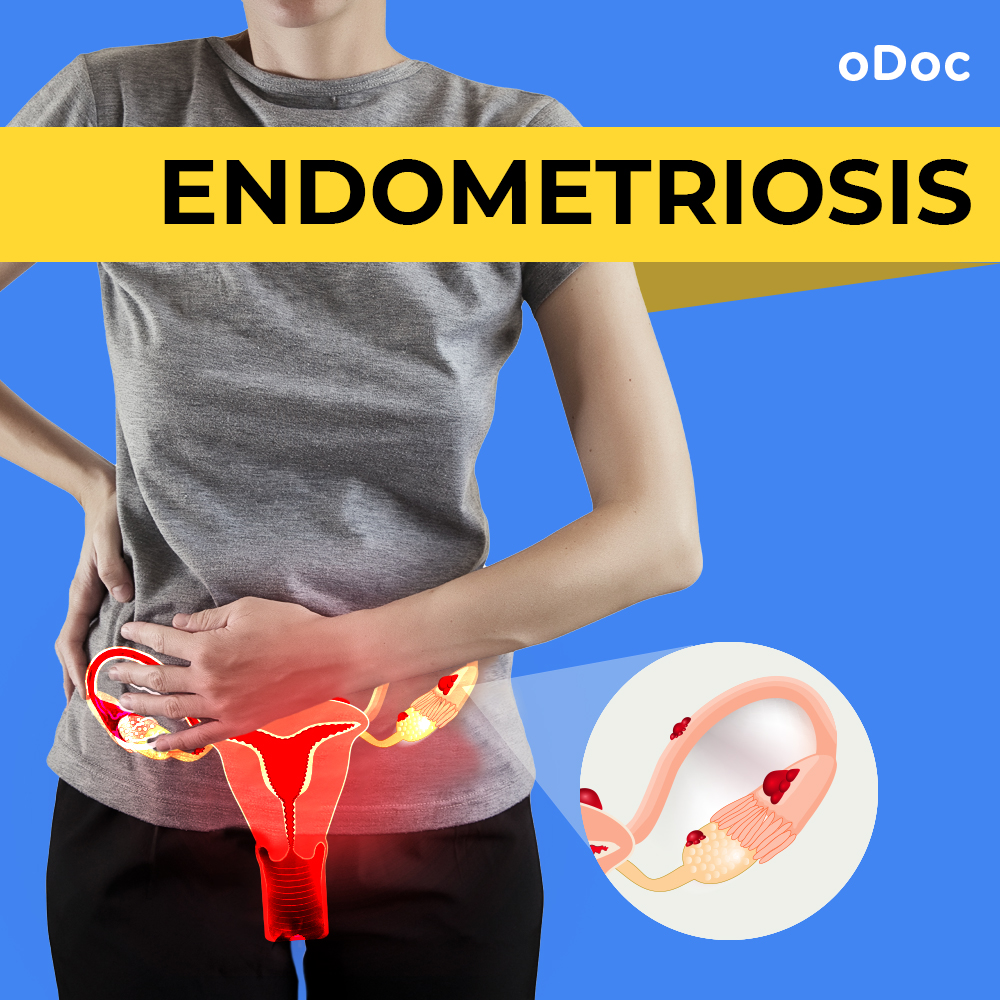 Endometriosis