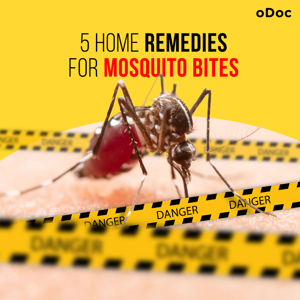 5 Home Remedies for Mosquito Bites