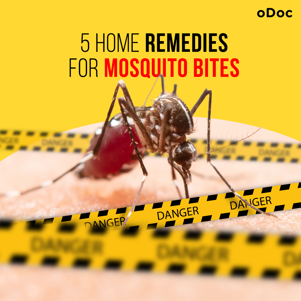 5 Best Home Remedies For Mosquito Bites From The ODoc Blog