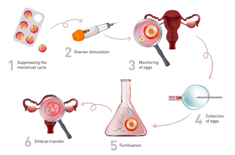 In-vitro Fertilisation Process